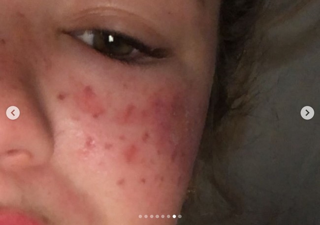 Influencer dan bintang reality show ini wajahnya penuh dengan bekas luka karena mengikuti trik kecantikan di TikTok. Bukannya jadi cantik, wanita bernama Tilly Whitfeld ini malah dilarikan ke rumah sakit.Foto: Instagram