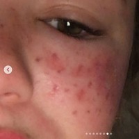 Influencer dan bintang reality show ini wajahnya penuh dengan bekas luka karena mengikuti trik kecantikan di TikTok. Bukannya jadi cantik, wanita bernama Tilly Whitfeld ini malah dilarikan ke rumah sakit.Foto: Instagram