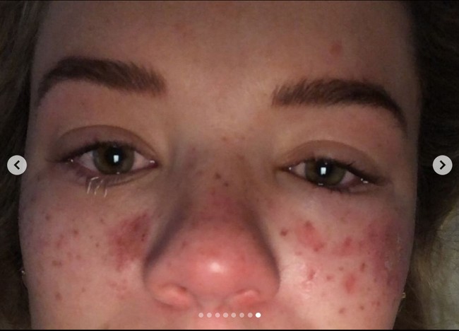 Meski sudah beberapa bulan berlalu, namun kondisi wajah Tilly masih terlihat seperti ini. Foto: Instagram