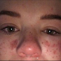 Meski sudah beberapa bulan berlalu, namun kondisi wajah Tilly masih terlihat seperti ini. Foto: Instagram