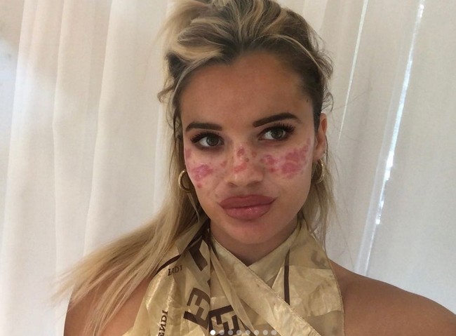 Beginilah kondisi wajahnya saat ini yamg masih memiliki banyak bekas luka. Foto: dok. Instagram