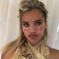 Beginilah kondisi wajahnya saat ini yamg masih memiliki banyak bekas luka. Foto: dok. Instagram