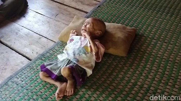 Pilu balita di Cianjur yang mengalami gizi buruk