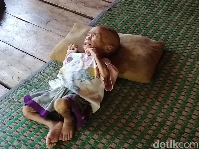 Pilu balita di Cianjur yang mengalami gizi buruk