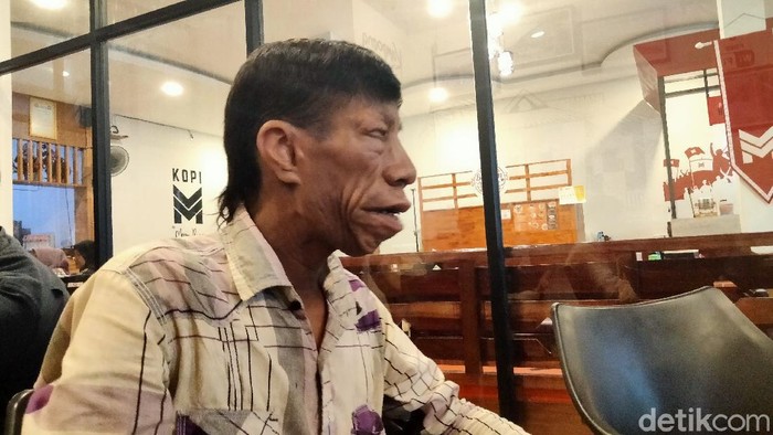 Syarif Surya Manurung (27) pemuda asal Kisaran Timur, Asahan, Sumut viral di medsos karena mengalami kondisi langka Treacher Collins Syndrome (Perdana R/detikcom)