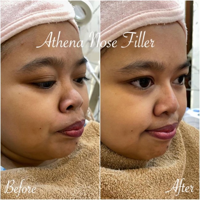 Inilah foto before dan after filler Kekeyi yang viral di media sosial. Tampak bahwa kini bagian hidungnya lebih tinggi dan area cuping hidung yang lebih kecil.  Foto: dok. Instagram