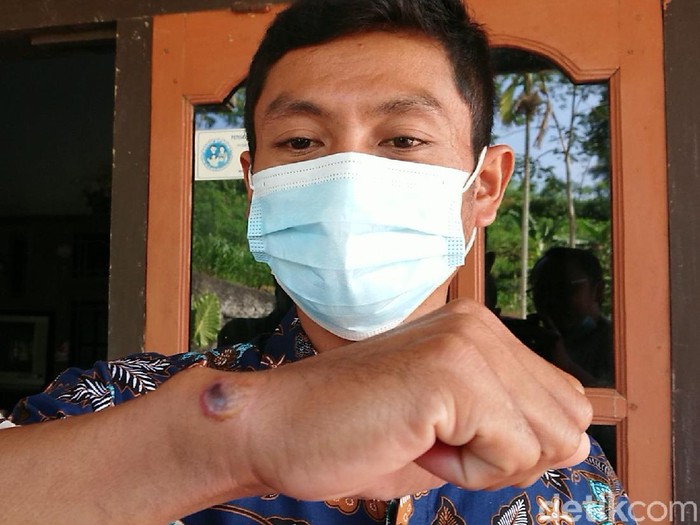 Kasus antraks di Tulungagung masih menjadi perhatian pemerintah daerah. Kepala Dusun Toro, Desa Sidomulyo, Kecamatan Pagerwojo, Agung Aris Saputra menjadi salah satu pasien yang diduga tertular antraks dari sapi.