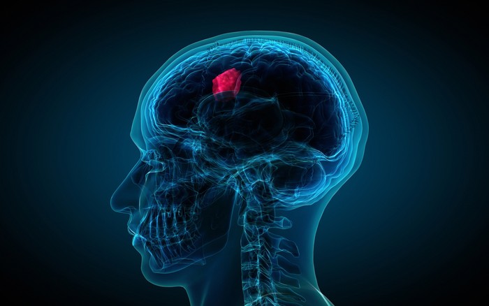x-ray of brain showing tumor. Computer generated images with correct male anatomy, showing brain with a glowing tumor inside.