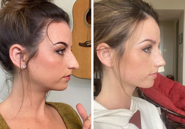 Wanita ini mengunggah foto before-after septorhinoplasty dalam dua minggu. Septorhinoplasty adalah prosedur operasi untuk mengubah bentuk hidung sekaligus memperbaiki saluran pernapasan melalui hidung. Foto: Reddit/ © vemrich