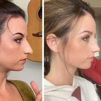 Wanita ini mengunggah foto before-after septorhinoplasty dalam dua minggu. Septorhinoplasty adalah prosedur operasi untuk mengubah bentuk hidung sekaligus memperbaiki saluran pernapasan melalui hidung. Foto: Reddit/ © vemrich