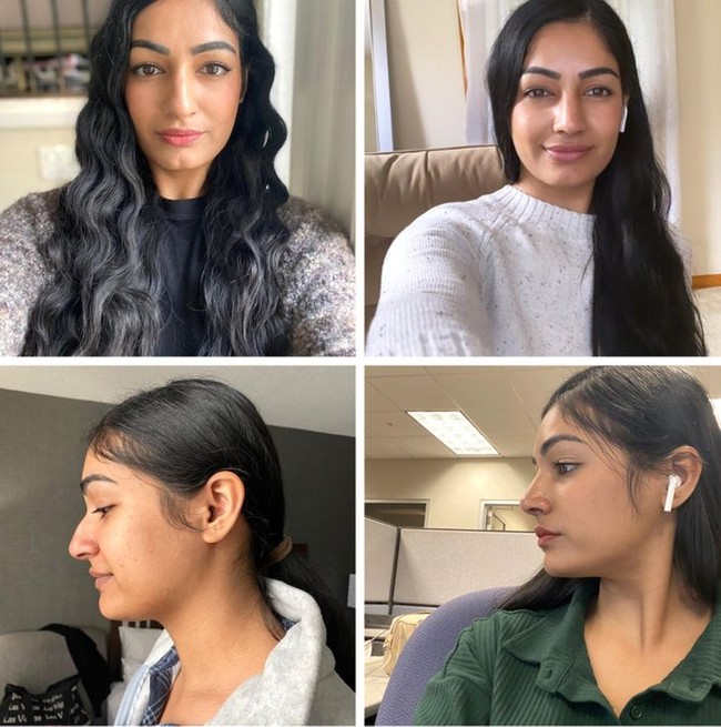 Wanita ini membagikan foto pemulihan setelah tiga minggu operasi plastik. Terlihat jelas perbedaan wajahnya yang berangsur-angsur berubah.Foto: Reddit/ © TimelessSmile