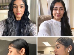 7 Transformasi Dramatis Pasien Operasi Hidung, Seperti Orang Lain