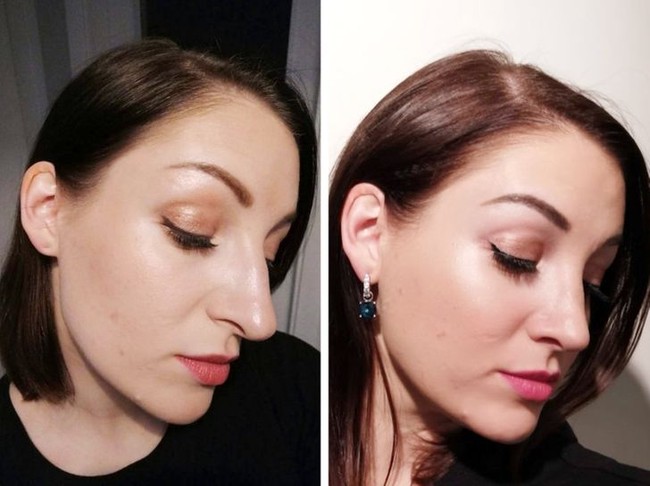 Memiliki hidung terlalu panjang membuat wanita ini kurang percaya diri. Dia pun merekonstruksi hidungnya jadi lebih proporsional. Ini perbedaan wajahnya loma bulan pascaoperasi. Foto: Reddit/ © nosejobadvice