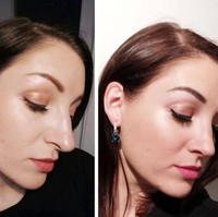 Memiliki hidung terlalu panjang membuat wanita ini kurang percaya diri. Dia pun merekonstruksi hidungnya jadi lebih proporsional. Ini perbedaan wajahnya loma bulan pascaoperasi. Foto: Reddit/ © nosejobadvice