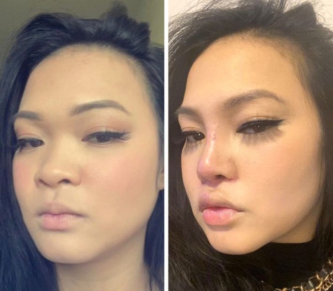 Ini penampilan pasien 12 hari setelah operasi hidung. Wanita berdarah Asia ini berubah penampilan dengan tulang hidung yang lebih tinggi dan lancip.Foto: Reddit/ © pizzanexcel