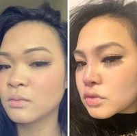 Ini penampilan pasien 12 hari setelah operasi hidung. Wanita berdarah Asia ini berubah penampilan dengan tulang hidung yang lebih tinggi dan lancip.Foto: Reddit/ © pizzanexcel