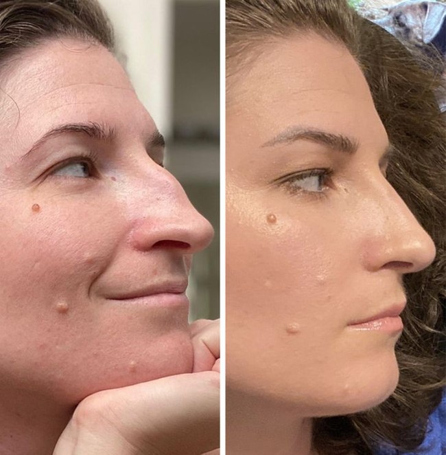 Wanita ini menjalani septorhinoplasty pada hidungnya yang bengkok di tengah. Setelah tujuh minggu, bentuk hidung jadi lebih lurus dan ia bisa bernapas lebih mudah. Foto: Reddit/ © bigolhonkinnose