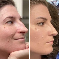 Wanita ini menjalani septorhinoplasty pada hidungnya yang bengkok di tengah. Setelah tujuh minggu, bentuk hidung jadi lebih lurus dan ia bisa bernapas lebih mudah. Foto: Reddit/ © bigolhonkinnose