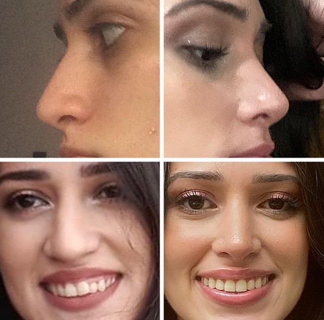 Foto ini merupakan perubahan setelah tujuh bulan menjalani prosedur septorhinoplasty. Sangat terlihat bedanya bukan? Foto: Reddit/ © norbegaby