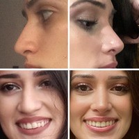 Foto ini merupakan perubahan setelah tujuh bulan menjalani prosedur septorhinoplasty. Sangat terlihat bedanya bukan? Foto: Reddit/ © norbegaby