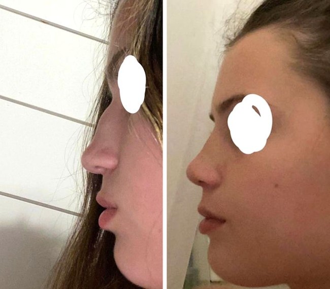 Hidung wanita ini awalnya memiliki tonjolan di bagian tulangnya (kiri). Setelah satu minggu rhinoplasty atau operasi hidung (kanan) wajahnya terlihat lebih proporsional. Foto: Reddit/ © BarracudaFunny1774