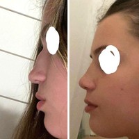 Hidung wanita ini awalnya memiliki tonjolan di bagian tulangnya (kiri). Setelah satu minggu rhinoplasty atau operasi hidung (kanan) wajahnya terlihat lebih proporsional. Foto: Reddit/ © BarracudaFunny1774