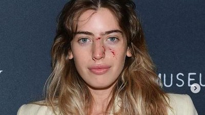 Muka Berdarah Usai Digigit Anjing, Putri Ewan McGregor Eksis di Red Carpet