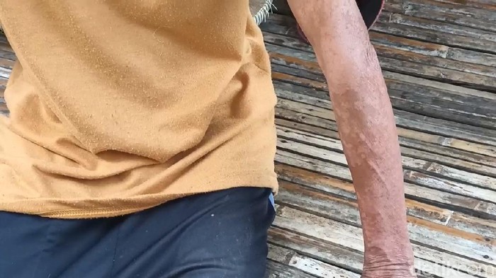 Warga Karawang mengeluhkan gatal-gatal diduga terkontaminasi limbah pabrik