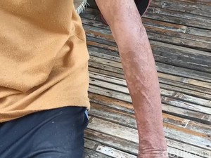 Diduga Terpapar Limbah Pabrik, 50 KK di Karawang Keluhkan Gatal-Batuk