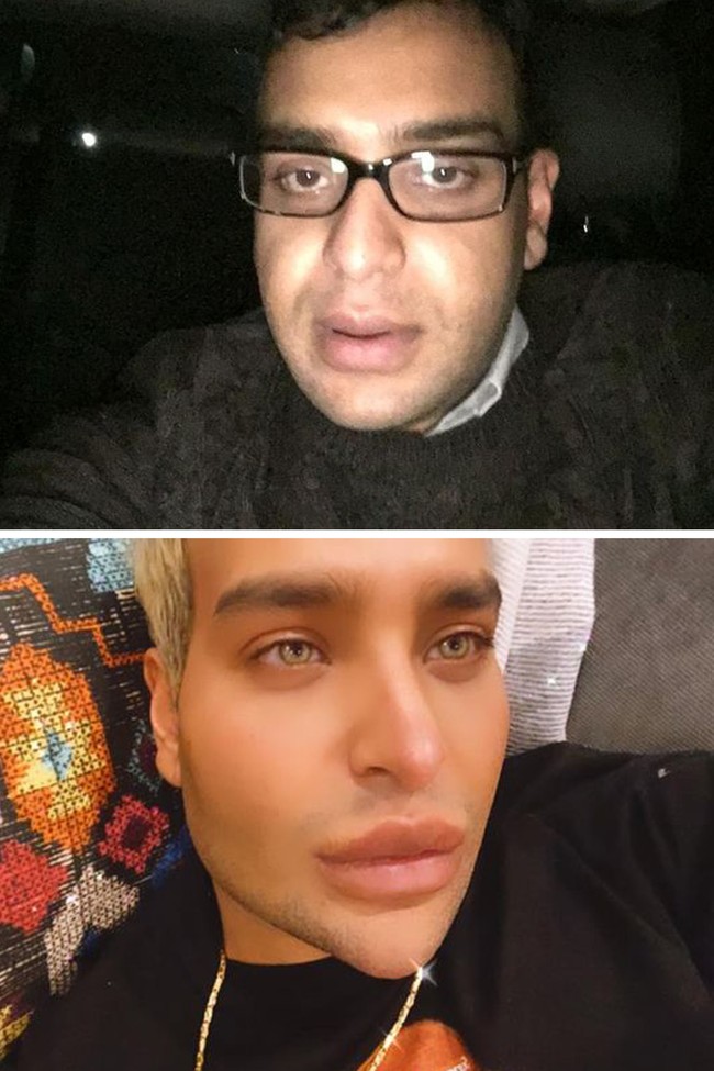 Selalu merasa tidak percaya diri dengan penampilannya, pria asal Whitefield, Manchester ini memutuskan untuk melakukan operasi plastik. Pria bernama Aneece Malik itu rela mengeluarkan uang sekitar Rp 2,6 miliar demi bisa memiliki wajah filter di dunia nyata. Foto: dok. Instagram/@aneece111