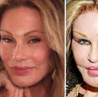 Sosialita asal Amerika Serikat yang bernama Jocelyn Wildenstein ini telah menghabiskan banyak uang untuk melakukan operasi demi mendapatkan wajah yang lebih cantik. Namun tak sesuai ekspetasi, wajahnya malah berakhir mirip seperti kucing. Karena hal itu, Jocelyn pun sering dijuluki catwoman. Jocelyn kabarnya telah melakukan operasi kelopak mata, pengencangan alis, face-lift, filler bibir dan dagu, implan pipi, serta cangkok lemak untuk mengencangkan kulitnya. Foto: Instagram