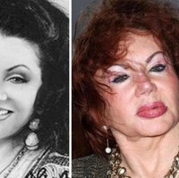 Ibu dari aktor Sylvester Stallone, Jackie Stallone juga menjadi salah satu korban dari operasi plastik yang dijalaninya. Jackie sendiri sempat mengungkapkan penyesalannya karena terlalu banyak melakukan operasi plastik pada wajahnya. Jackie melakukan filler pada bibir dan pipi, serta face lift yang membuat wajahnya berubah. Foto: viralshare