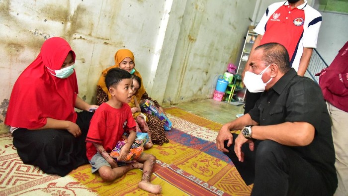 Edy saat menjenguk 2 anak dengan sakit kulit di Madina (dok. Pemprov Sumut)