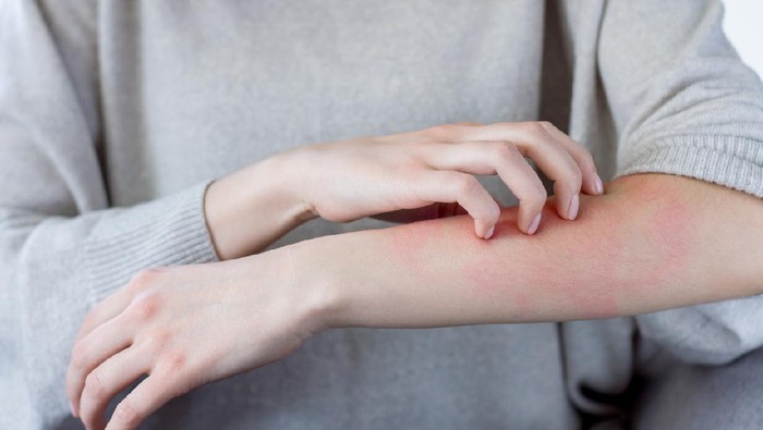 Closeup girl is scratching her hand with nails. Reddened, inflamed body parts causes discomfort and itching. Young woman is suffering from bouts of allergies. Dermatological skin diseases concept.