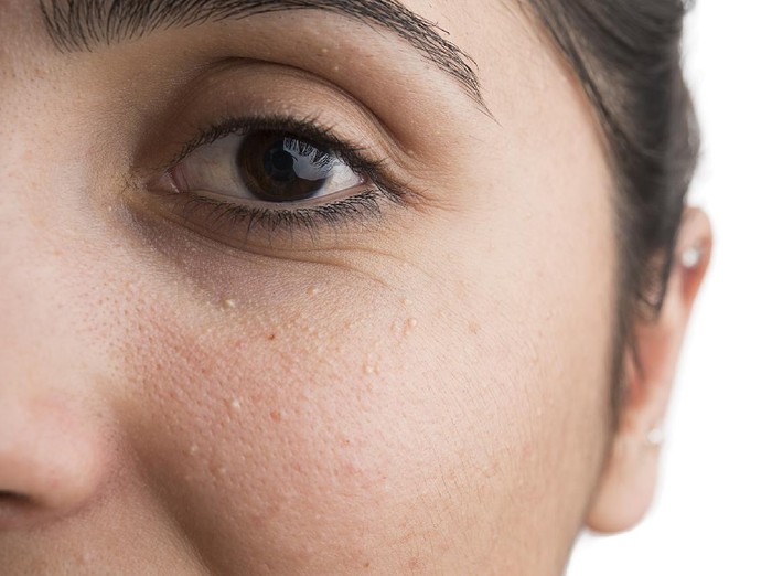 bekas jerawat Young woman has problems with skin on the face