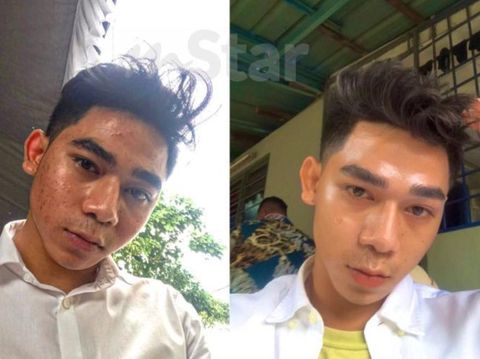 Transformasi wajah pria jerawatan viral