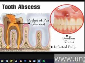 Dosen Unpad Jelaskan Efek Gigi Mati yang Dibiarkan: Infeksi Sampai Hidung
