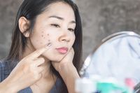 8 Cara Menghilangkan Noda Hitam Bekas Jerawat Pakai Skincare Hingga Alami