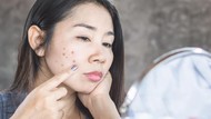 8 Cara Menghilangkan Noda Hitam Bekas Jerawat Pakai Skincare Hingga Alami