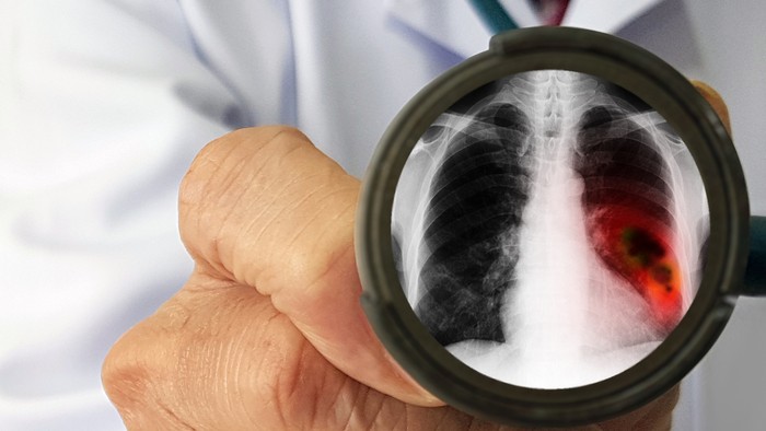 Doctors physical examination for screening lung cancer