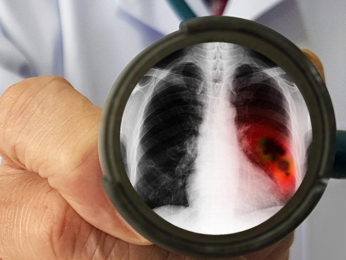 Doctors physical examination for screening lung cancer