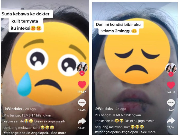 Viral kisah wanita yang bibirnya bernanah karena kebiasaan mengelupas kulit bibir. Viral kisah wanita yang bibirnya bernanah karena kebiasaan mengelupas kulit bibir.