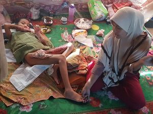 Bocah di Polman Alami Luka Bakar Kena Minyak Panas, Ortu Kesulitan Biaya