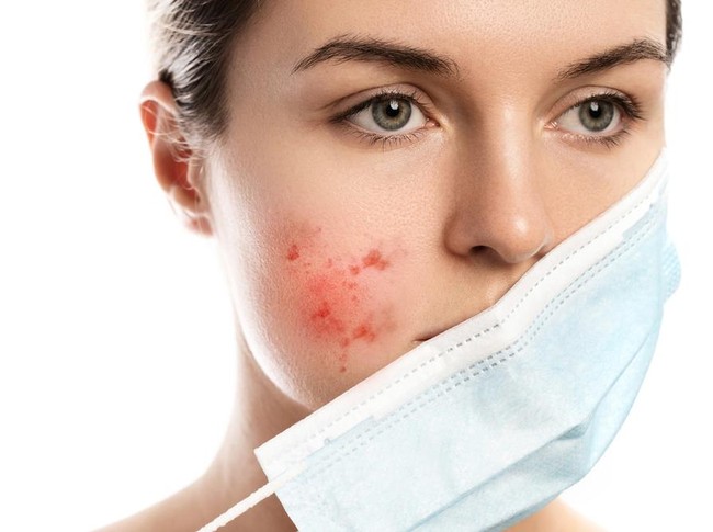 Bermasker Bikin Jerawat