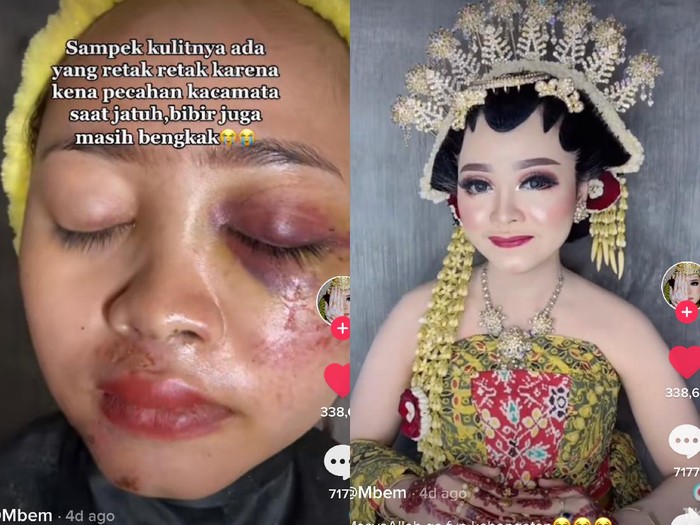 Jelang pernikahan, wajah pengantin ini penuh luka dan sukses bikin pangling saat hari pernikahan. Jelang pernikahan, wajah pengantin ini penuh luka dan sukses bikin pangling saat hari pernikahan.
