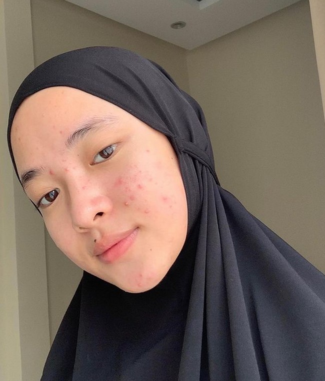 Nissa Sabyan juga berani menunjukkan wajah tanpa makeup. Kala itu, wajah Nisa tengah berjerawat. Penampilannya itu mendapatkan banyak hujatan netizen.Foto: dok. Instagram/@nissa_sabyan