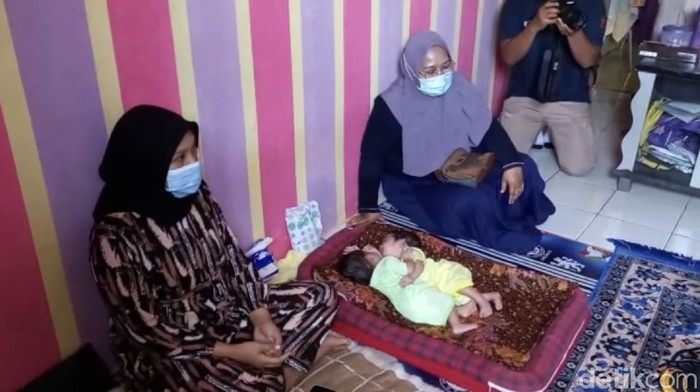 Bayi kembar siam asal Sukabumi