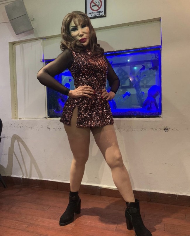 Aktris dengan nama asli Liliana Mendiola Mayans itu pernah mengungkapkan dalam sebuah wawancara dia harus melakukan beberapakali operasi plastik setelah wajahnya mengalami pembengkakan akibat baby oil yang dioleskannya ke mukanya tersebut. Baby oil tersebut didapatkannya dari seorang wanita yang mengatakan minyak tersebut dapat membuatnya tampak awet muda. Foto: Dok. Instagram @ lyn_may_