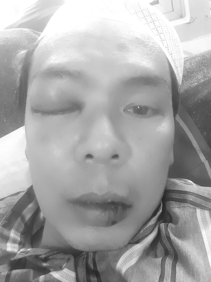 Penampakan Ryan Jombang Usai Dipukul Bahar Smith di Lapas Gunung Sundur. (Dok.istimewa)
