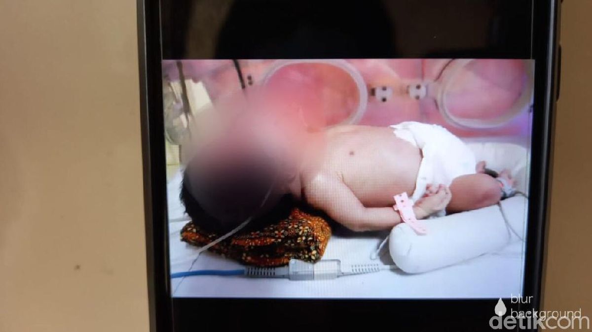 Kembar Siam Satu Tubuh Berkepala Dua Di Tegal Akhirnya Meninggal Dunia